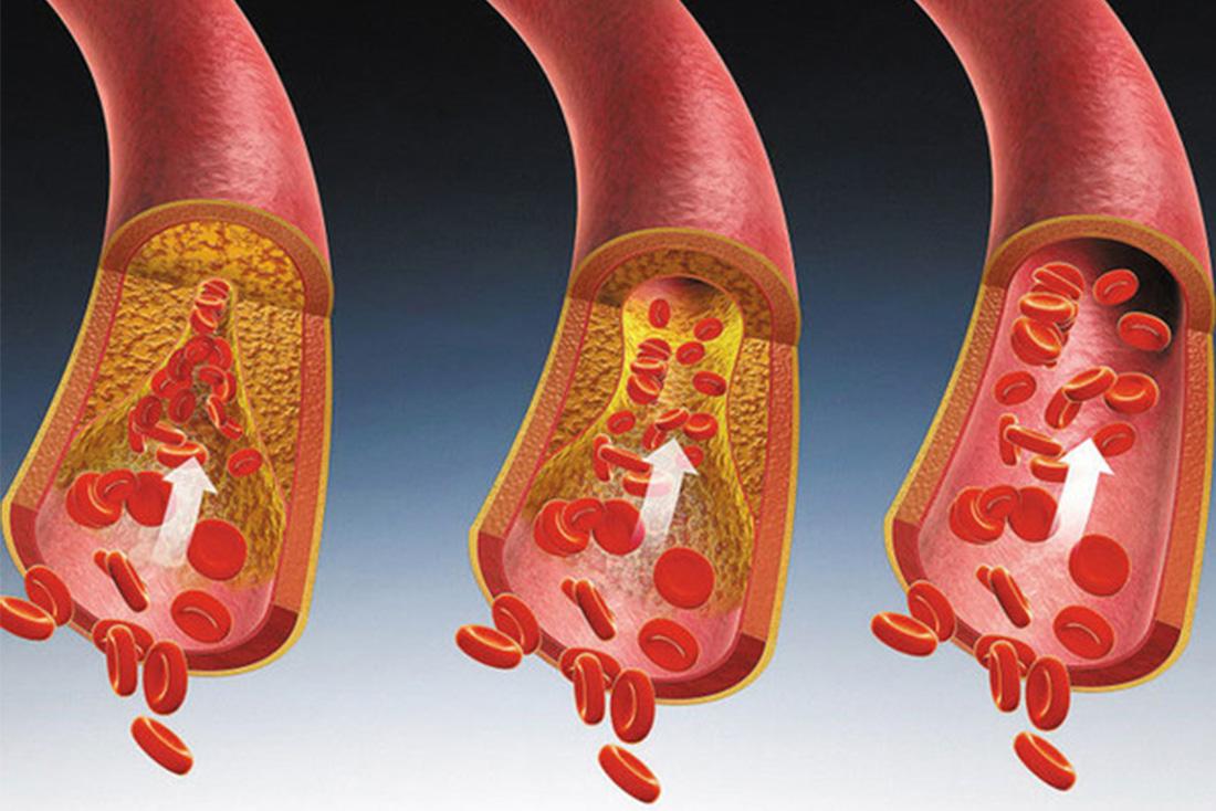 展示高血脂是如何堵塞血管的